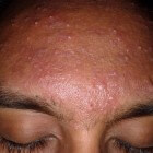 Puistjes op voorhoofd: verwijderen van acne in het gezicht