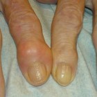 Artrose van de vingers: oorzaak en behandeling vingerartrose