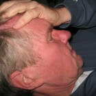 Spinale hoofdpijn: Hoofdpijn na ruggenprik (lumbale punctie)