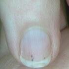 Splinterbloeding: Kleine, donkere lijntjes onder nagels