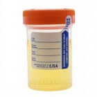 Urine: pijn, irritatie, branderig gevoel plassen of urineren