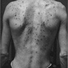 Acne Vulgaris (jeugdpuistjes) bestrijden, behandeling, tips