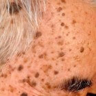Bruine vlekken op de huid: nek, hand, gezicht, schouder, arm