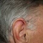 Ontsteking oorschelp: Chondrodermatitis Nodularis Helicis