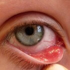 Strontje in het oog: symptomen, oorzaak en behandeling