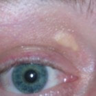 Xanthelasma: verwijderen gele cholesterolbultjes rond ogen