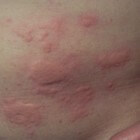 Wat veroorzaakt een allergische reactie van de huid