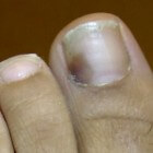 Bloeduitstorting onder de nagel: oorzaken van blauwe nagel