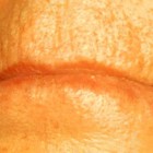 Rimpels: verwijderen van rimpels bovenlip en onder de ogen