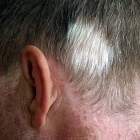 Poliosis circumscripta: witte pluk haar op het hoofd