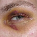 Blauw oog: symptomen, oorzaken en behandeling blauwe plek