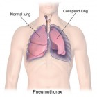 Klaplong: symptomen, behandeling en herstel (pneumothorax)