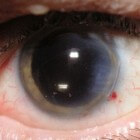 Multifocale en trifocale lensimplantatie