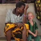 Albinos in Tanzania  slachtoffers van medicijnmannen