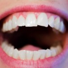 Gevoelige tanden & blootliggende tandhalzen