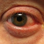 Ogentroost: helpt bij rode en branderige ogen
