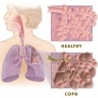 Longziekte COPD: Chronic Obstructive Pulmonary Disease