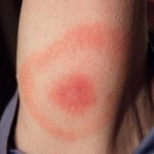 Rode huidkringen door de ziekte van Lyme