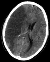 CT-scan hersenen met groot herseninfarct van rechterhersenhelft (donkerder gekleurde linkerhelft op het plaatje) / Bron: Lucien Monfils, Wikimedia Commons (CC BY-SA-3.0)