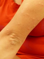 Bij een allergische reactie als gevolg van een mierenbeet ontstaan mogelijk (jeukende) bultjes op de huid / Bron: Hans, Pixabay