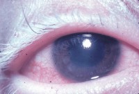 Poliosis van de wimpers (witte wimpers) / Bron: National Eye Institute, Wikimedia Commons (Publiek domein)