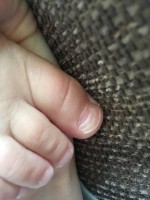 Aangedane nagel bij tweejarig kind met hand-, voet- en mondziekte / Bron: Martin Sulman