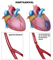 Ontstaan van een hartinfarct / Bron: Alila Medical Media/Shutterstock.com