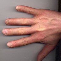 Loslatende nagel bij lichen striatus / Bron: CopperKettle, Wikimedia Commons (CC BY-SA-3.0)