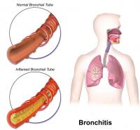 Bronchitis / Bron: BruceBlaus, Wikimedia Commons (CC BY-SA-4.0)