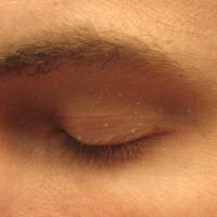 Milia op een ooglid, zichtbaar als kleine witte puntjes op ooglid / Bron: Silver442n, Wikimedia Commons (Publiek domein)
