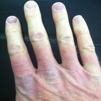 Koude, dove, pijnlijke, gezwollen vingers bij fenomeen van Raynaud / Bron: WaltFletcher, Wikimedia Commons (CC BY-SA-4.0)