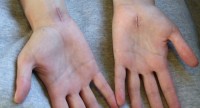 Littekens van een operatie van het carpaal tunnel syndroom. Twee verschillende technieken zijn gebruikt. Het linker litteken is 6 weken oud, het rechter litteken is 2 weken oud. Een jaar later was de vrouwelijke patiënt volledig hersteld. / Bron: HenrykGerlach, Wikimedia Commons (CC BY-SA-3.0)
