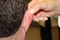 Basaalcelcarcinoom op het oor: een vorm van huidkanker / Bron: Kelly Nelson (Photographer), Wikimedia Commons (Publiek domein)