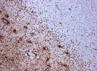 Oligodendrocyten zijn de cellen die myeline produceren. De macrofagen, op deze microscopie-foto bruin gekleurd, beschadigen het myeline.  / Bron: Marvin 101, Wikimedia Commons (CC BY-SA-3.0)