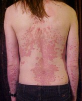 psoriasis op rug en armen. / Bron: The Wednesday Island, Wikimedia Commons (CC BY-SA-3.0)