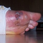 Blaasjes op voet (en hand): oorzaken voet- & handblaasjes