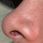 Huidaandoening neus: schilfering, pijn, zweertjes, roodheid