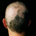 Trichotillomanie: dwangmatig haren uit het hoofd trekken