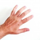 gallon Bruin Ambtenaren Huidkloven, vingerkloven en handkloven: oorzaak, behandeling | Mens en  Gezondheid: Aandoeningen