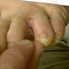 Schilfers tussen tenen: oorzaken van huidschilfers en jeuk