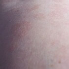 Morfea: een vlekkerige huidaandoening