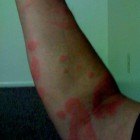 Urticaria: rode jeukende bultjes op huid, buik, armen, benen