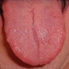 Bultjes op de tong: oorzaken van witte of rode tongbultjes