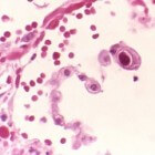 Infectie met het cytomegalovirus (CMV): cytomegalie