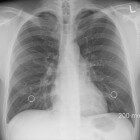 Ademhalingsstoornissen – Kussmaul-ademhaling