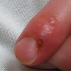 Ontstoken nagelriem vinger: symptomen - nagel laat los