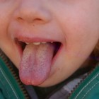 Witte aanslag op de tong: oorzaken en symptomen witte tong
