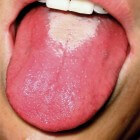 Vlekken op de tong: oorzaken rode, witte en zwarte vlekken