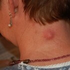 Klein knobbeltje in hals/nek: links of rechts, zonder pijn