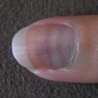 Mees' lines: witte horizontale lijnen in nagel teen/vinger